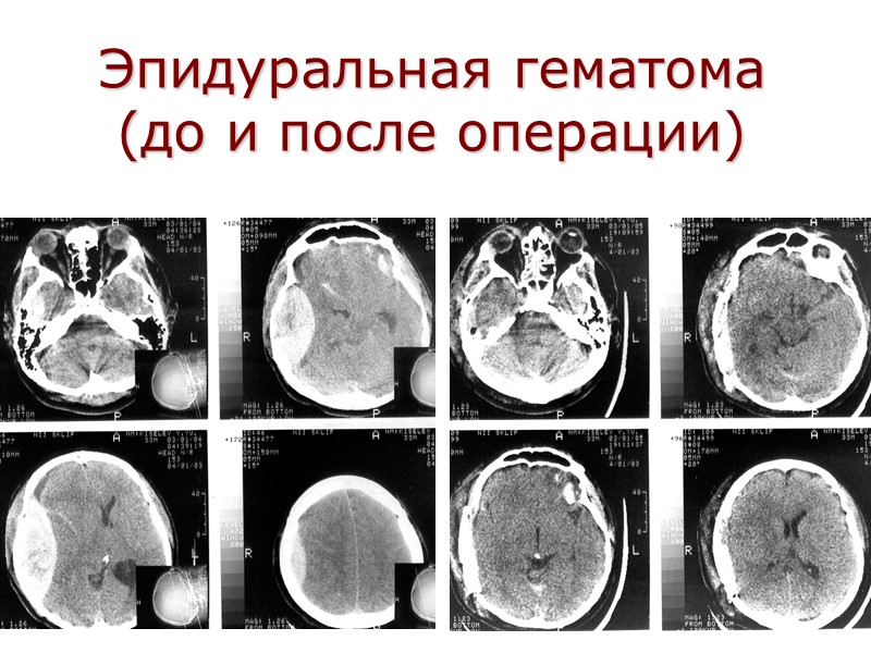 Эпидуральная гематома  (до и после операции)
